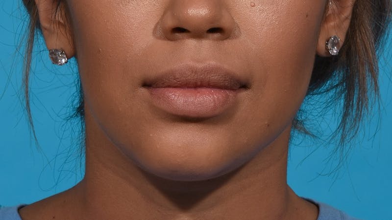 Chin Liposuction Before & After Gallery - Patient 384056 - Image 2