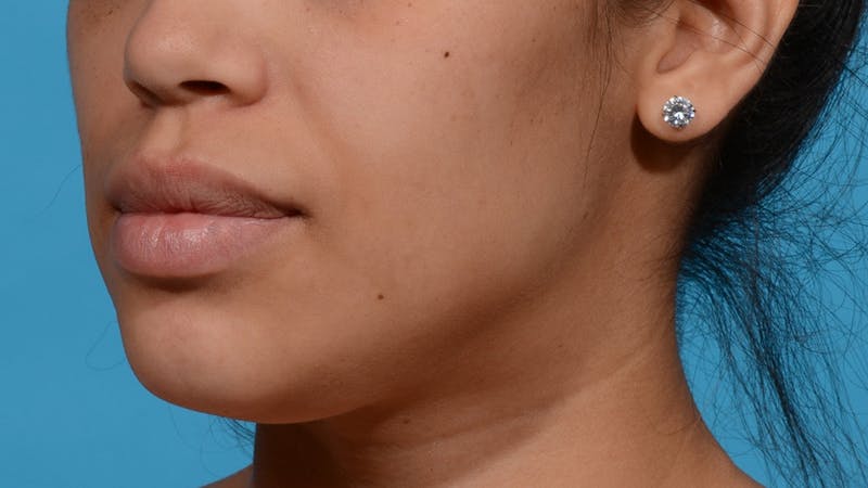 Chin Liposuction Before & After Gallery - Patient 384056 - Image 3