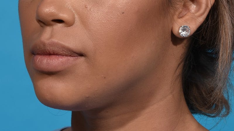 Chin Liposuction Before & After Gallery - Patient 384056 - Image 4