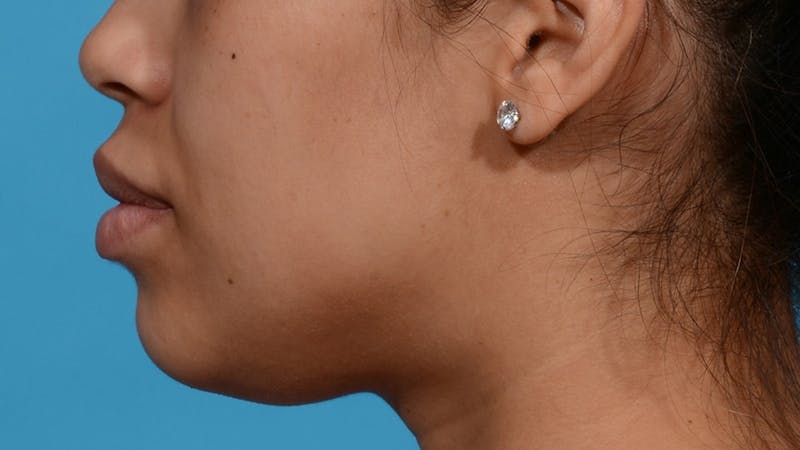 Chin Liposuction Before & After Gallery - Patient 384056 - Image 5