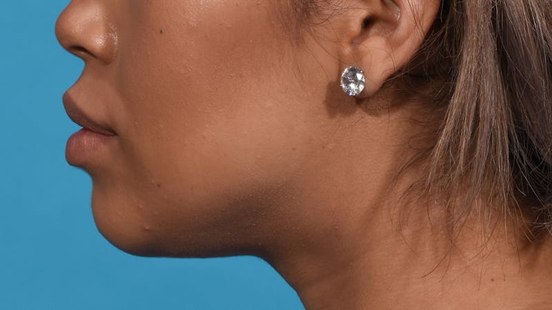 Chin Liposuction Before & After Gallery - Patient 384056 - Image 6