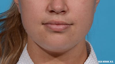 Chin Liposuction Before & After Gallery - Patient 235233 - Image 1
