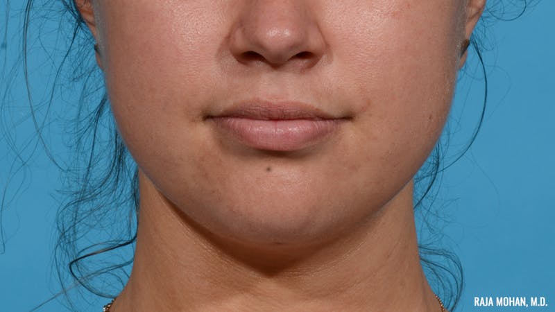 Chin Liposuction Before & After Gallery - Patient 235233 - Image 2