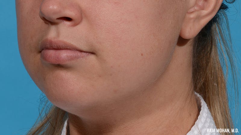 Chin Liposuction Before & After Gallery - Patient 235233 - Image 3