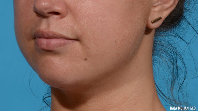 Chin Liposuction Before & After Gallery - Patient 235233 - Image 4