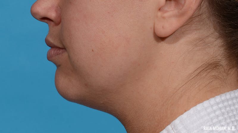 Chin Liposuction Before & After Gallery - Patient 235233 - Image 5