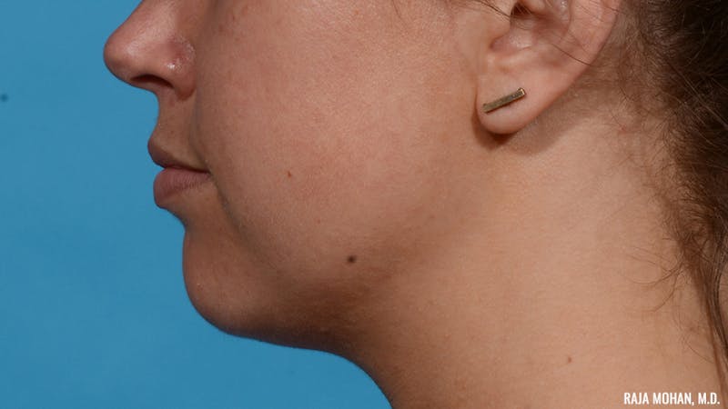 Chin Liposuction Before & After Gallery - Patient 235233 - Image 6