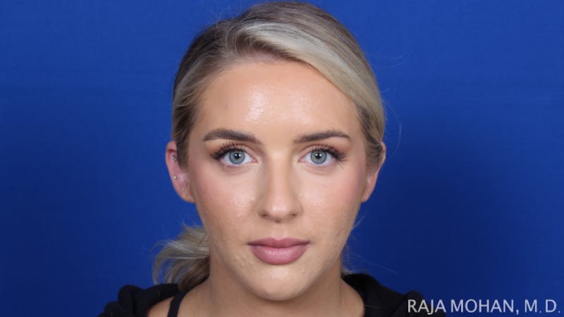 Chin Liposuction Before & After Gallery - Patient 149170 - Image 1