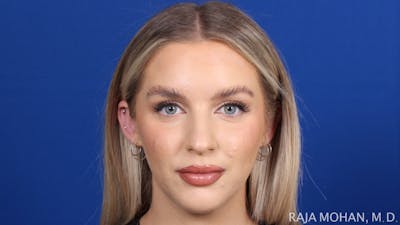 Chin Liposuction Before & After Gallery - Patient 149170 - Image 2