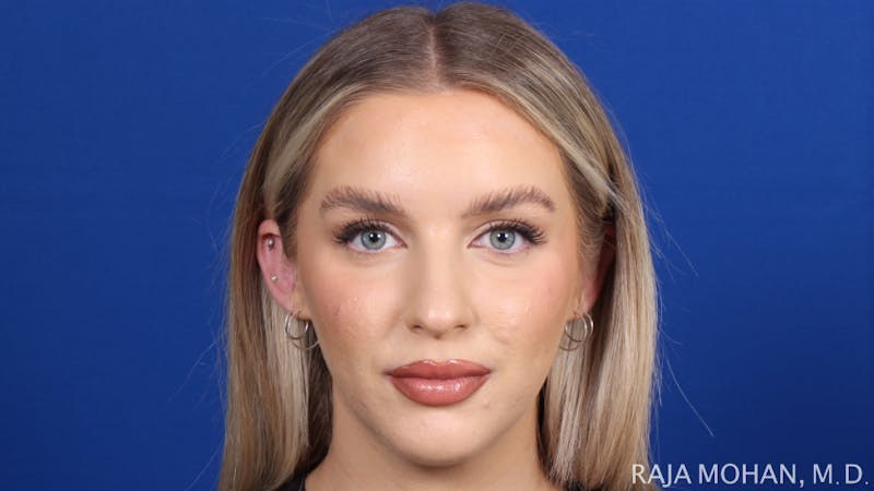 Chin Liposuction Before & After Gallery - Patient 149170 - Image 2