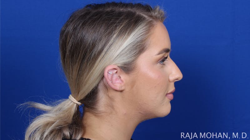 Chin Liposuction Before & After Gallery - Patient 149170 - Image 3