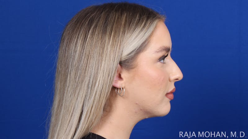 Chin Liposuction Before & After Gallery - Patient 149170 - Image 4
