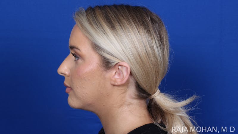 Chin Liposuction Before & After Gallery - Patient 149170 - Image 5
