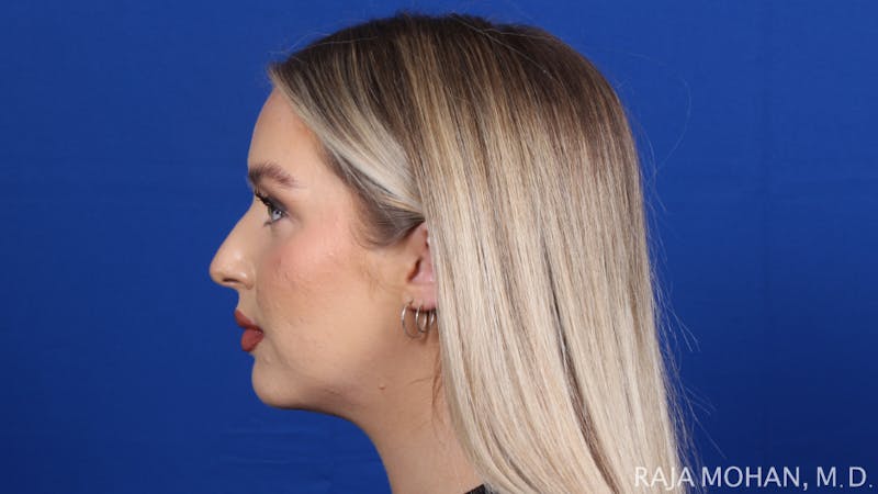 Chin Liposuction Before & After Gallery - Patient 149170 - Image 6