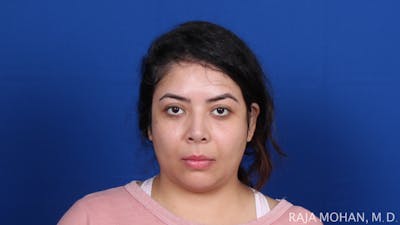 Chin Liposuction Before & After Gallery - Patient 311367 - Image 1