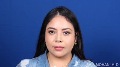 Chin Liposuction Before & After Gallery - Patient 311367 - Image 2