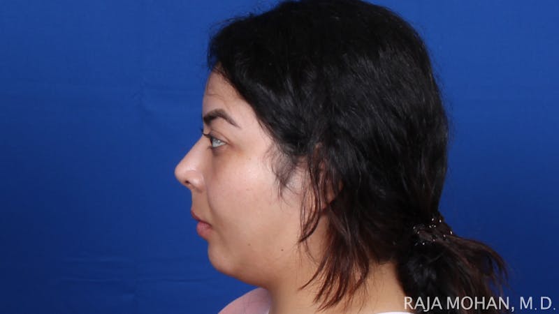 Chin Liposuction Before & After Gallery - Patient 311367 - Image 3