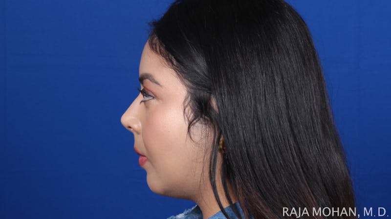 Chin Liposuction Before & After Gallery - Patient 311367 - Image 4