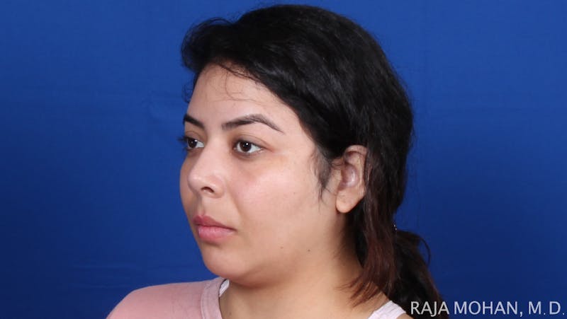 Chin Liposuction Before & After Gallery - Patient 311367 - Image 5