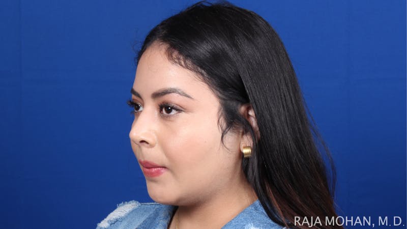 Chin Liposuction Before & After Gallery - Patient 311367 - Image 6