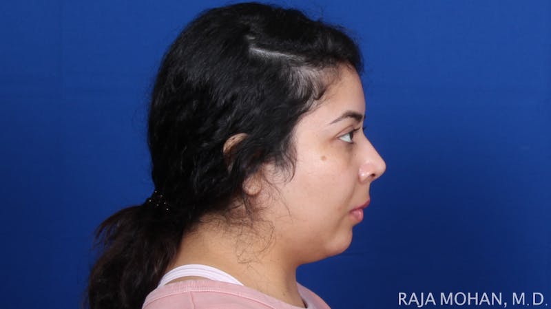 Chin Liposuction Before & After Gallery - Patient 311367 - Image 7