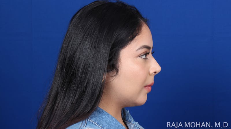 Chin Liposuction Before & After Gallery - Patient 311367 - Image 8