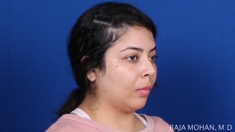 Chin Liposuction Before & After Gallery - Patient 311367 - Image 9