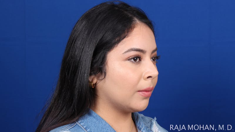 Chin Liposuction Before & After Gallery - Patient 311367 - Image 10
