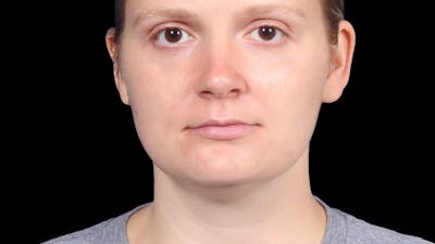 Chin Liposuction Before & After Gallery - Patient 176431 - Image 1
