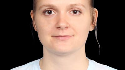 Chin Liposuction Before & After Gallery - Patient 176431 - Image 2