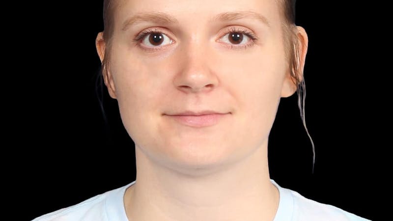 Chin Liposuction Before & After Gallery - Patient 176431 - Image 2