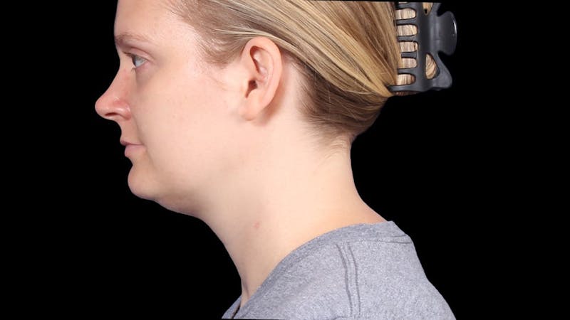 Chin Liposuction Before & After Gallery - Patient 176431 - Image 3