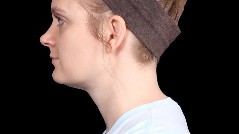 Chin Liposuction Before & After Gallery - Patient 176431 - Image 4