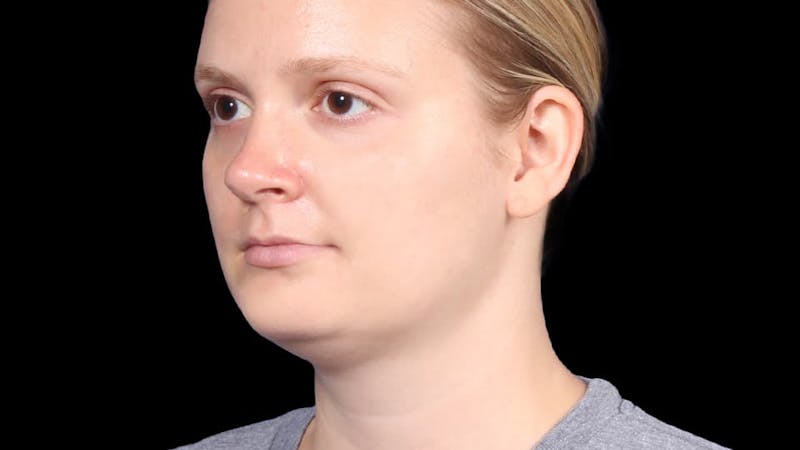 Chin Liposuction Before & After Gallery - Patient 176431 - Image 5