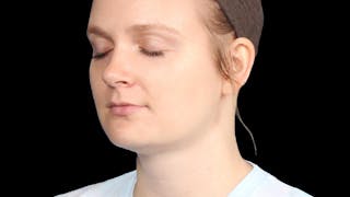 Chin Liposuction Before & After Gallery - Patient 176431 - Image 6