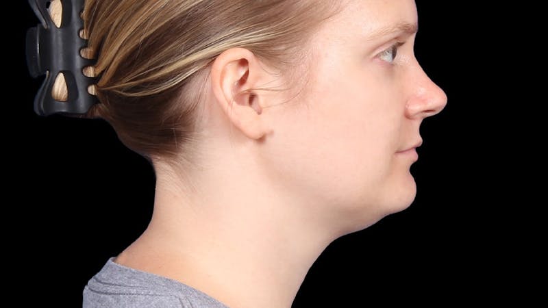 Chin Liposuction Before & After Gallery - Patient 176431 - Image 7