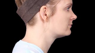 Chin Liposuction Before & After Gallery - Patient 176431 - Image 8