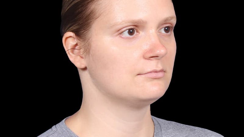 Chin Liposuction Before & After Gallery - Patient 176431 - Image 9