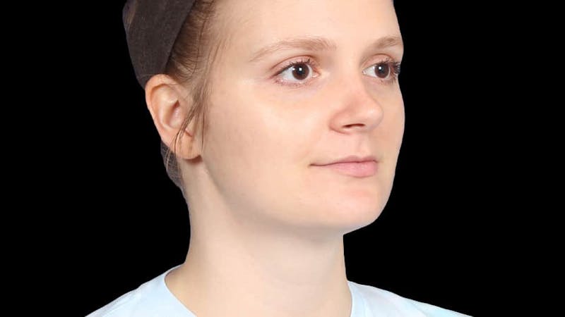 Chin Liposuction Before & After Gallery - Patient 176431 - Image 10