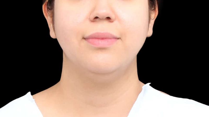 Chin Liposuction Before & After Gallery - Patient 213334 - Image 1