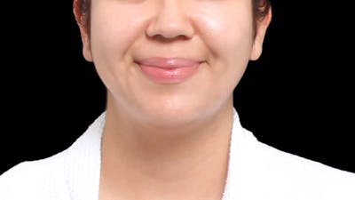 Chin Liposuction Before & After Gallery - Patient 213334 - Image 2