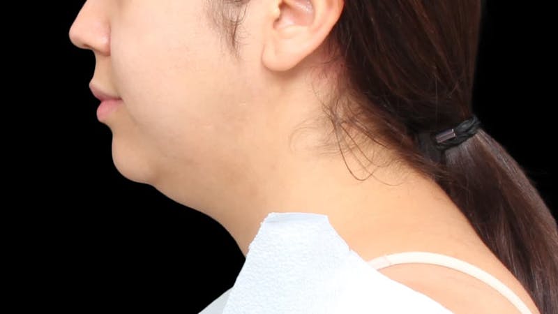 Chin Liposuction Before & After Gallery - Patient 213334 - Image 3