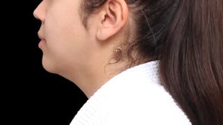 Chin Liposuction Before & After Gallery - Patient 213334 - Image 4
