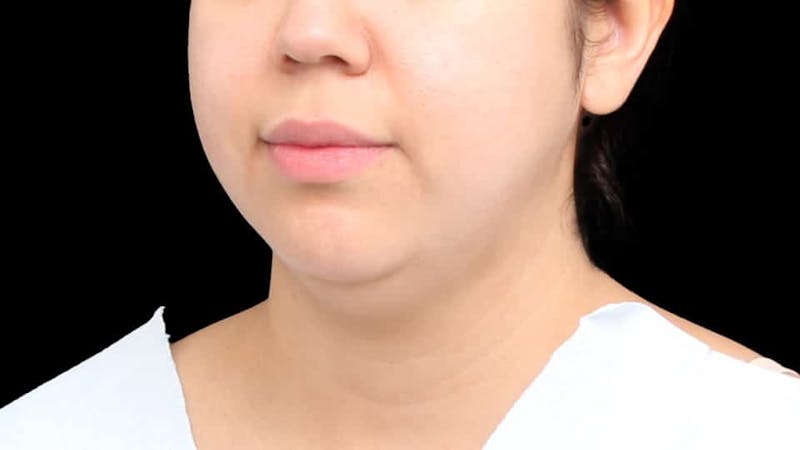 Chin Liposuction Before & After Gallery - Patient 213334 - Image 5