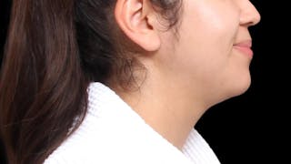 Chin Liposuction Before & After Gallery - Patient 213334 - Image 8