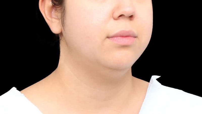 Chin Liposuction Before & After Gallery - Patient 213334 - Image 9