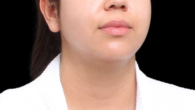 Chin Liposuction Before & After Gallery - Patient 213334 - Image 10