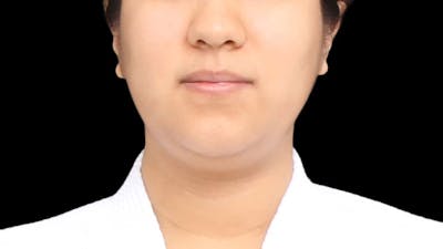 Chin Liposuction Before & After Gallery - Patient 366161 - Image 1