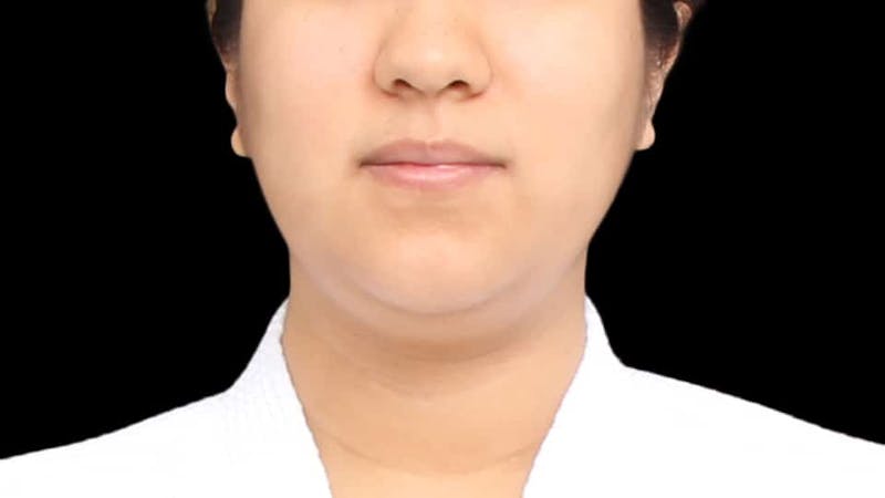 Chin Liposuction Before & After Gallery - Patient 366161 - Image 1