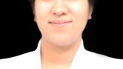 Chin Liposuction Before & After Gallery - Patient 366161 - Image 2